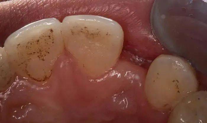 详解马里兰桥,你真的掌握了吗?