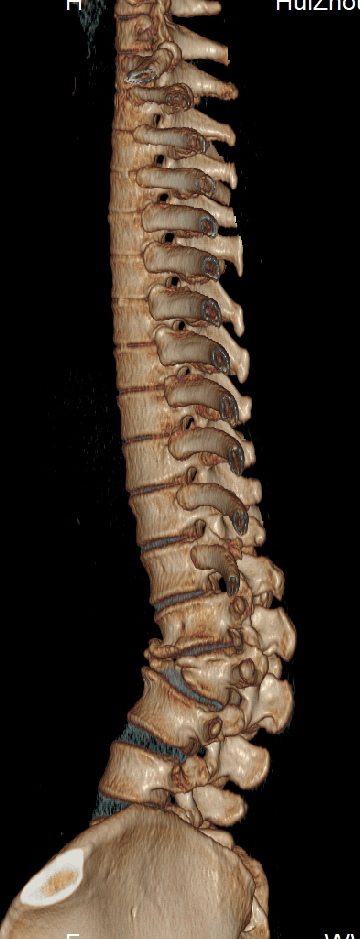 半脊柱扭转图片