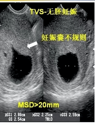 怀孕早期b超图 一个月图片