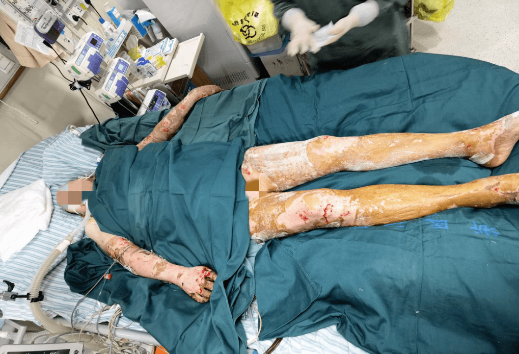 双向转诊的意义在救治因煤气爆炸而特重度烧伤的患者身上得到了体现