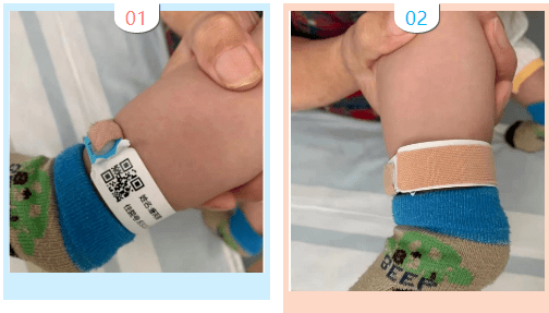 创新腕带佩戴方法:评估患儿选择合适的部位,先比划腕带调至合适大小
