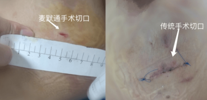 警惕女人腋下多这么一坨小赘肉危害竟有这么大