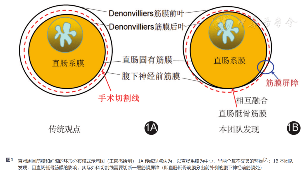 直肠环周切缘示意图图片