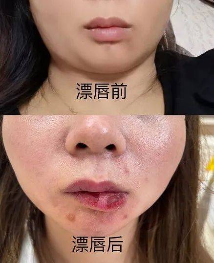 說好的粉嫩嘟嘟唇結果變成又腫又歪的豬大腸美容院回覆