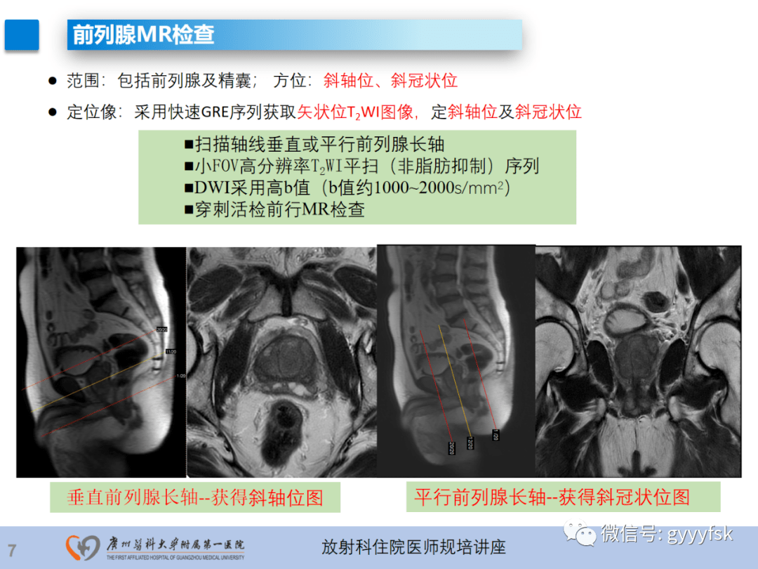 磁共振前列腺图像解析图片