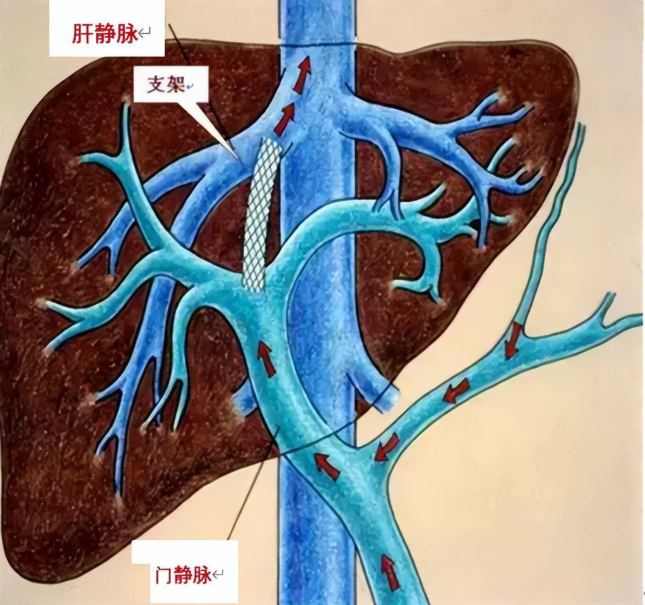 对于肝硬化的门静脉血栓形成,您了解了吗?