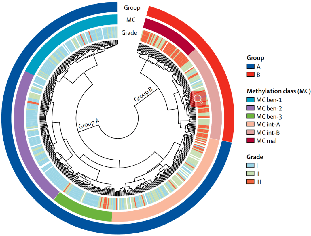 阔然开朗基于dna甲基化的脑膜瘤分类系统
