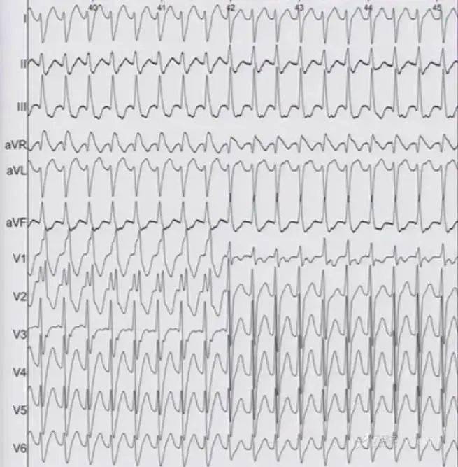 室速心电图图形图片