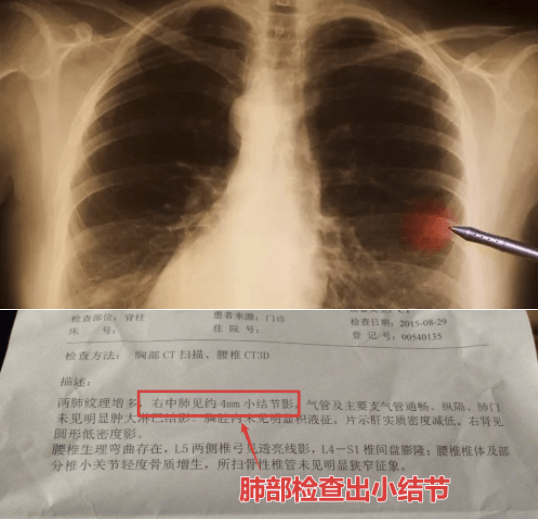 有研究表明,做肺部ct的人中20%都查出过肺结节.