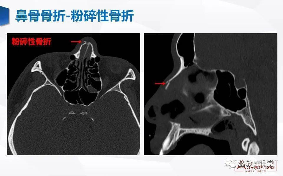 鼻骨断层解剖图片