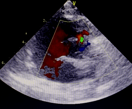 室间隔缺损超声图解图片