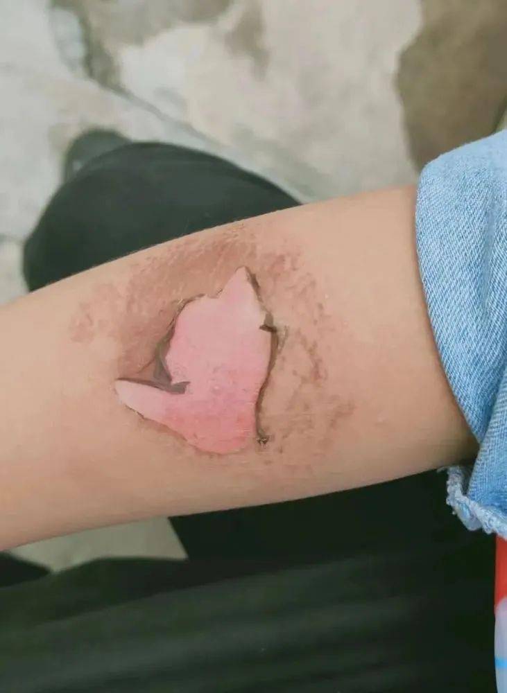 文山多名小学生被这款喷雾灼伤皮肤大面积变黑起泡脱皮