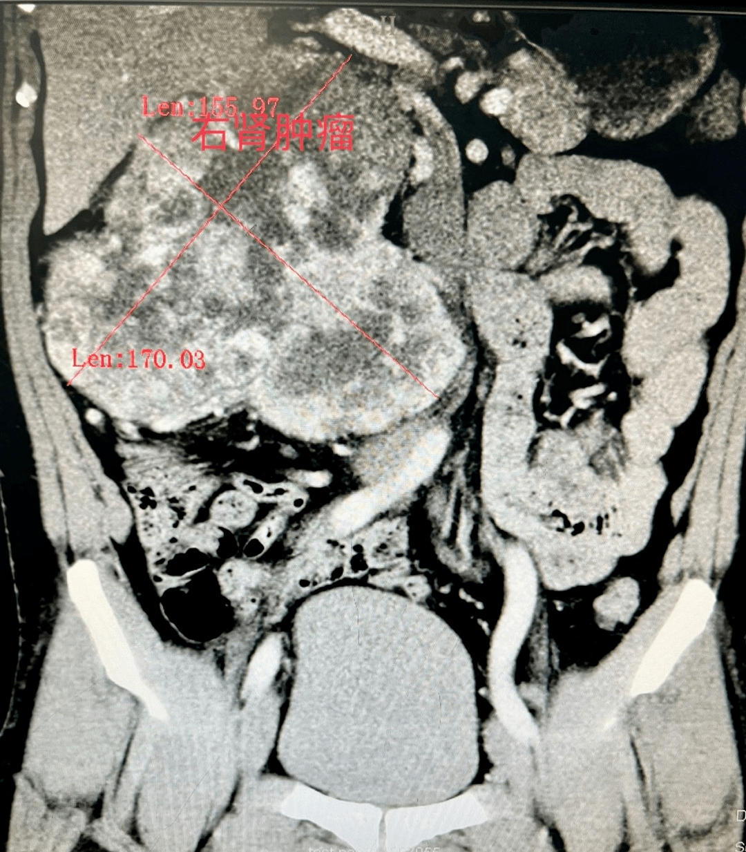 玉林一男子右肾长出巨型肾肿瘤重达17公斤