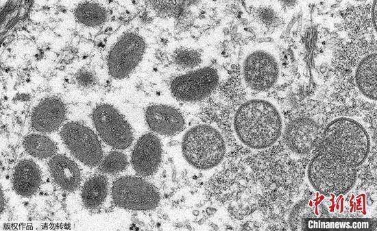 南非：现有猴痘确诊病例感染病毒来自西非毒株