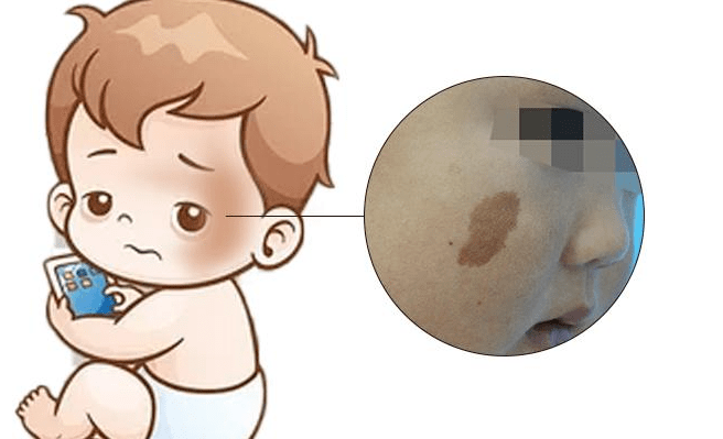牛奶斑 来自搜狐网
