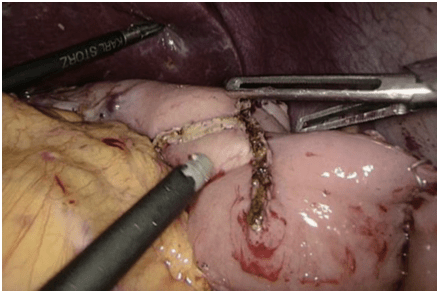后,于肝肾隐窝,十二指肠残端及吻合口后方放置扁平引流管一根(图19)