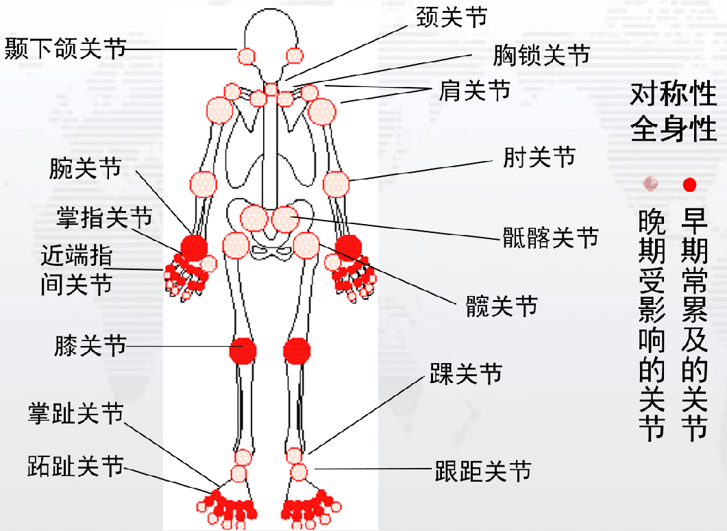 类风湿关节炎表现诊断和治疗建议