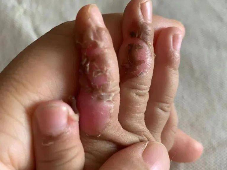 宝宝家中被电击手部烫伤医生换药好心疼