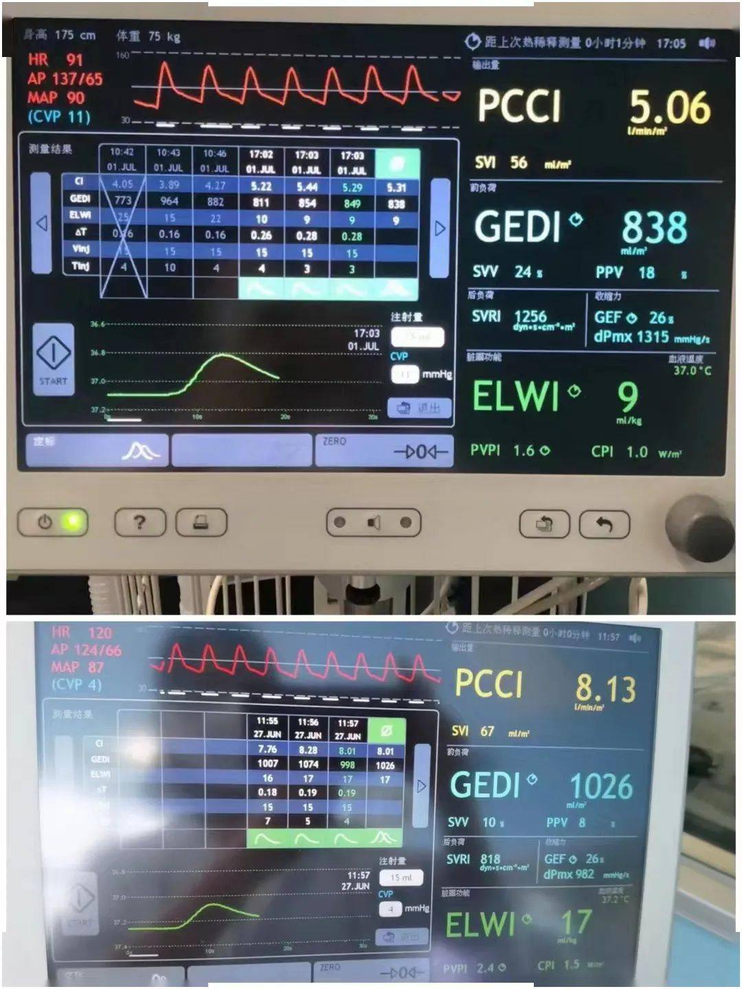 可怕港城一男子开空调险丧命深夜紧急入院连一医ecmo小分队11天惊险