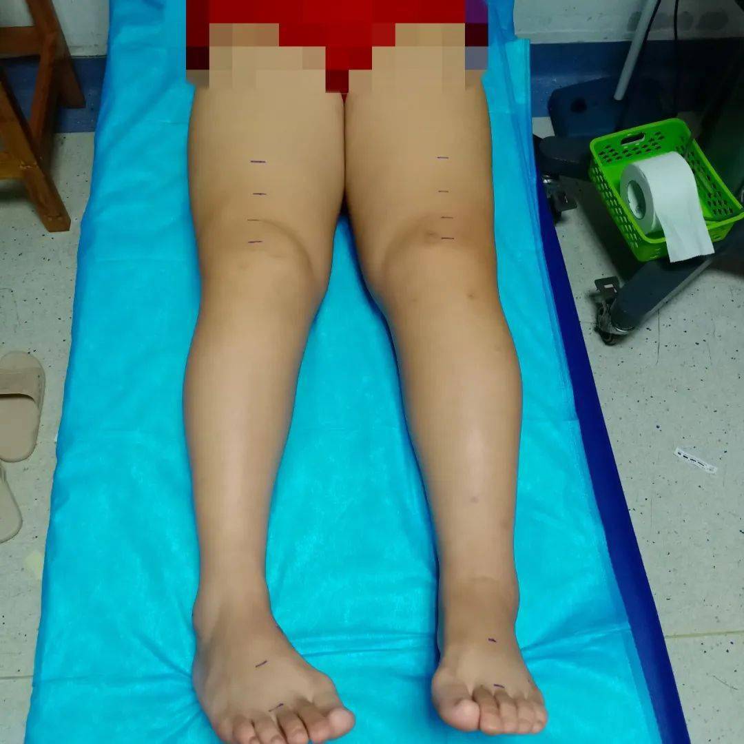 女子宫颈癌手术后，腿肿似“象腿”，医生用这一招成功“消肿”