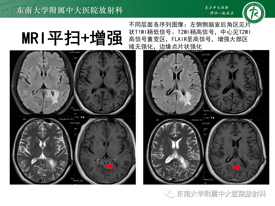 脫髓鞘假瘤影像學表現