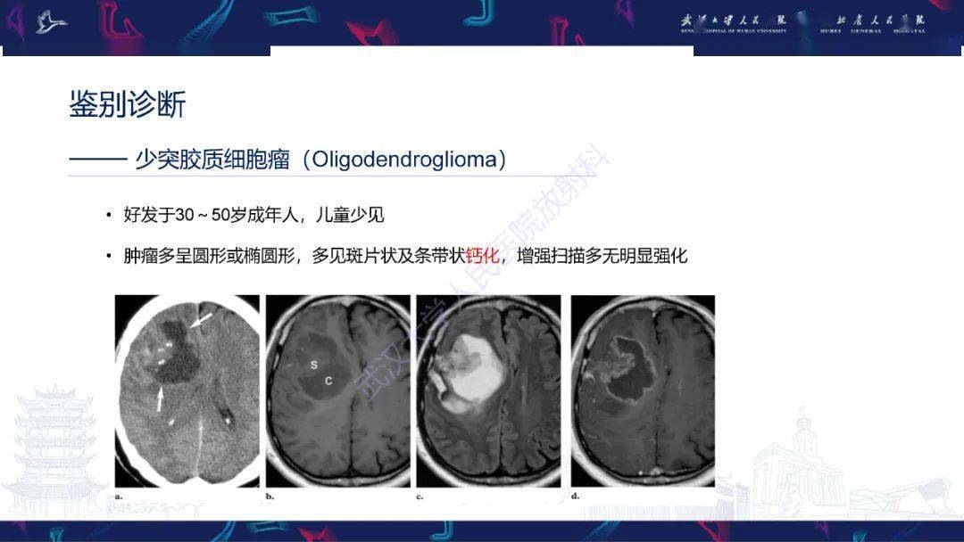 脑节细胞胶质瘤影像诊断
