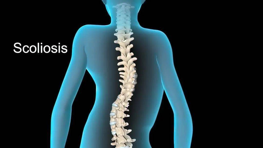 [儿科医生说健康]青少年脊柱侧弯 scoliosis