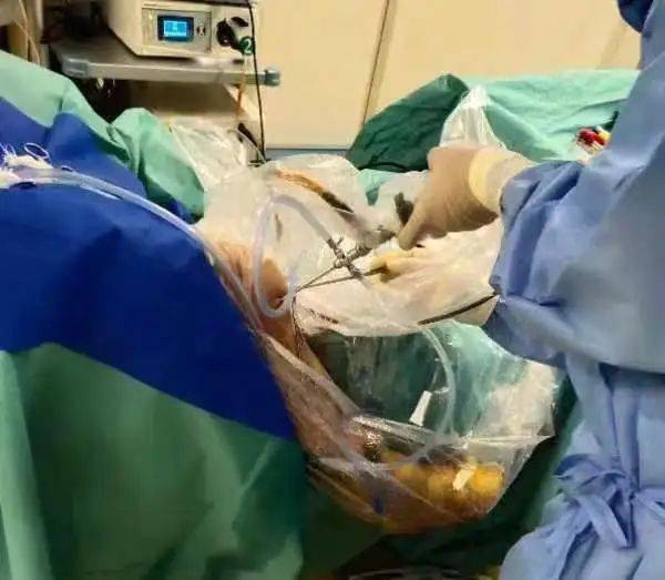 为患者解除膝关节病痛 —— 齐医附属一院成功完成关节镜下腘窝囊肿