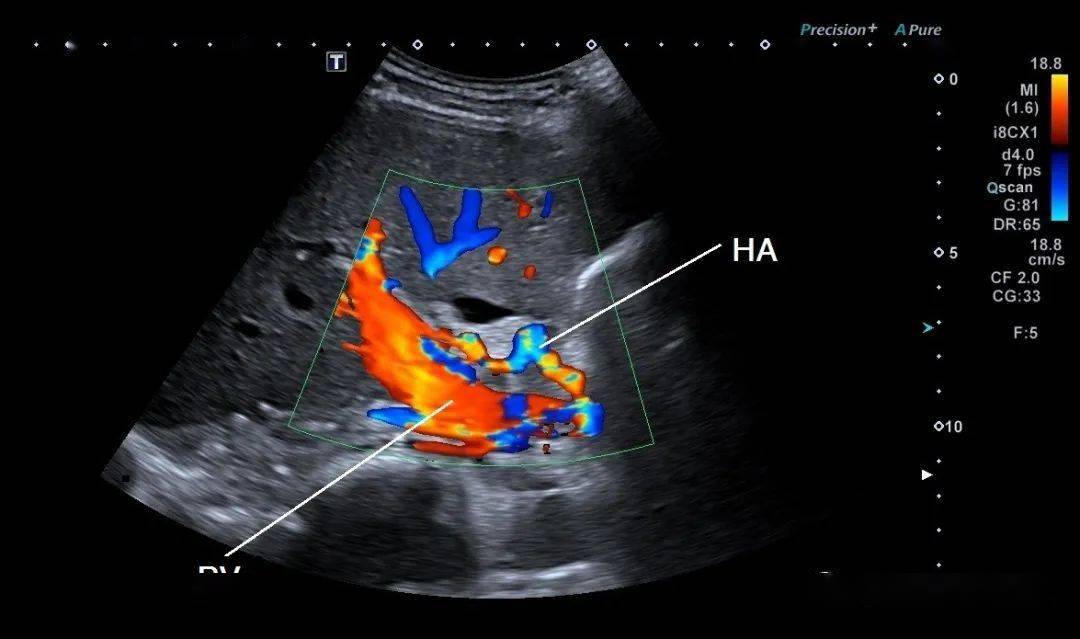 肝门静脉超声解剖图图片
