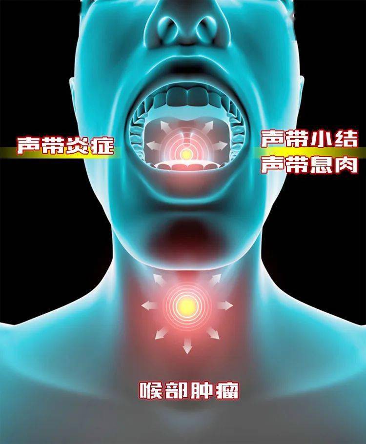 声音嘶哑,可能是病变信号,但很多人忽视了……_声带_患者_炎症