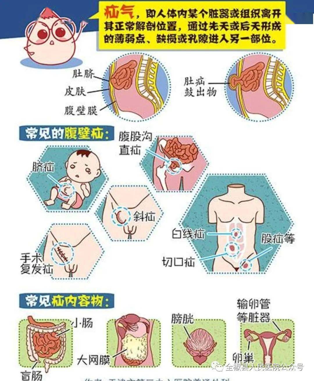 其他类型(食道裂孔疝,白线疝,切口疝,造口旁疝)等.
