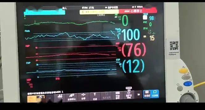 ecmo正式运转的那一刻,小虞的心电图呈一条直线,即心脏已处于停跳状态