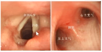 气管镜进镜技巧图解图片