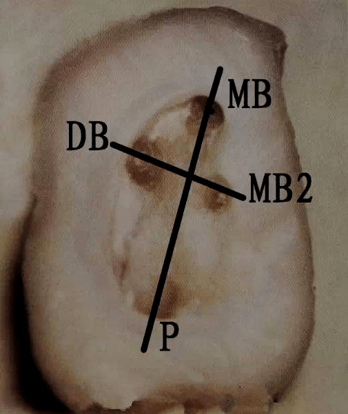 髓腔和根管口的解剖規律 :