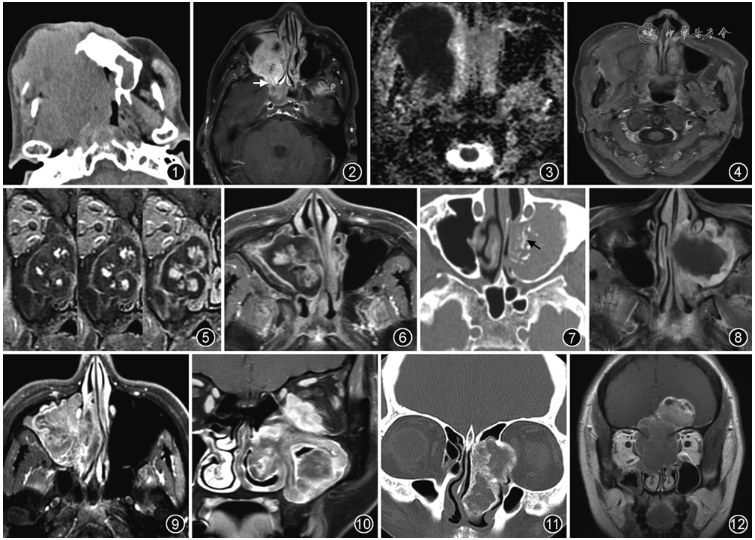鼻腔鼻竇腫瘤和腫瘤樣病變的影像學分析思路