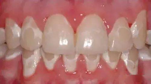 快照照镜子,看看你的牙上有白斑吗?可能是牙齿脱矿了!