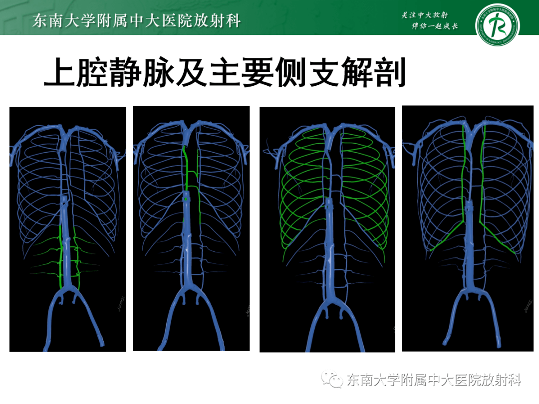 上腔静脉解剖图ct图片