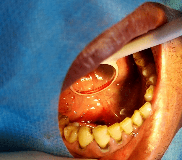 齐医附属一院口腔二科门诊成功探取国内罕见巨大颌下腺导管结石1例及