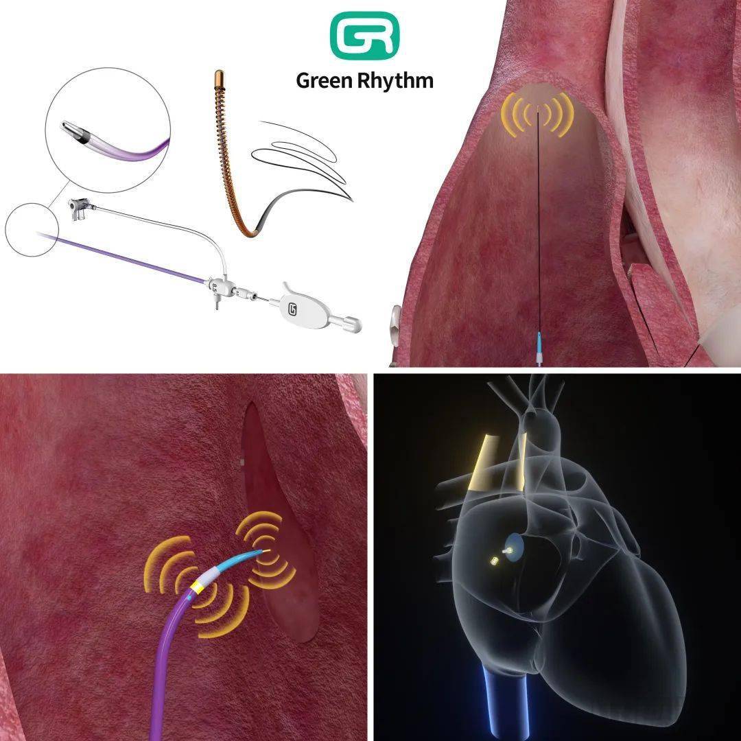 三维定位心内导引系统产品图 企业供图房间隔穿刺是心脏介入医生必须