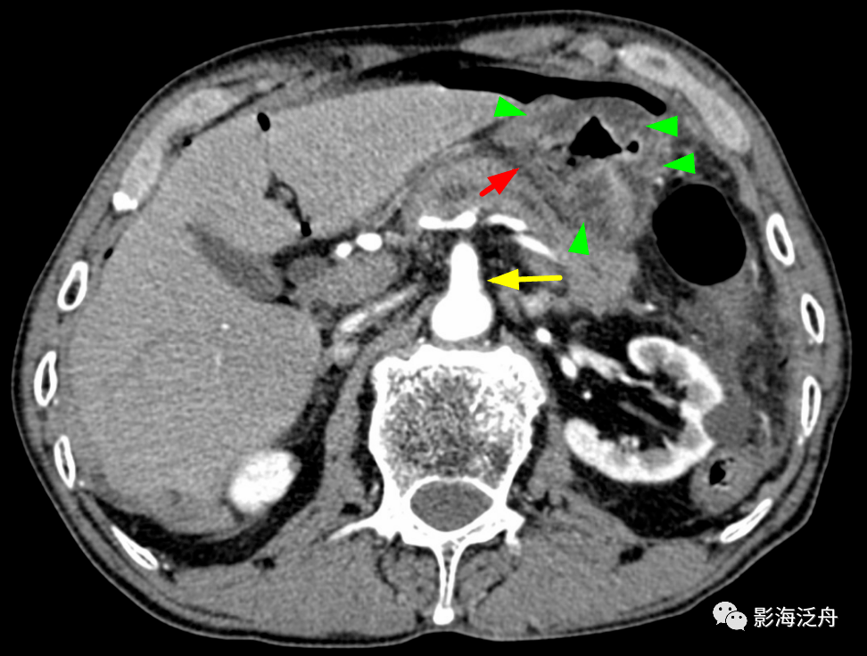 消化道穿孔CT图片