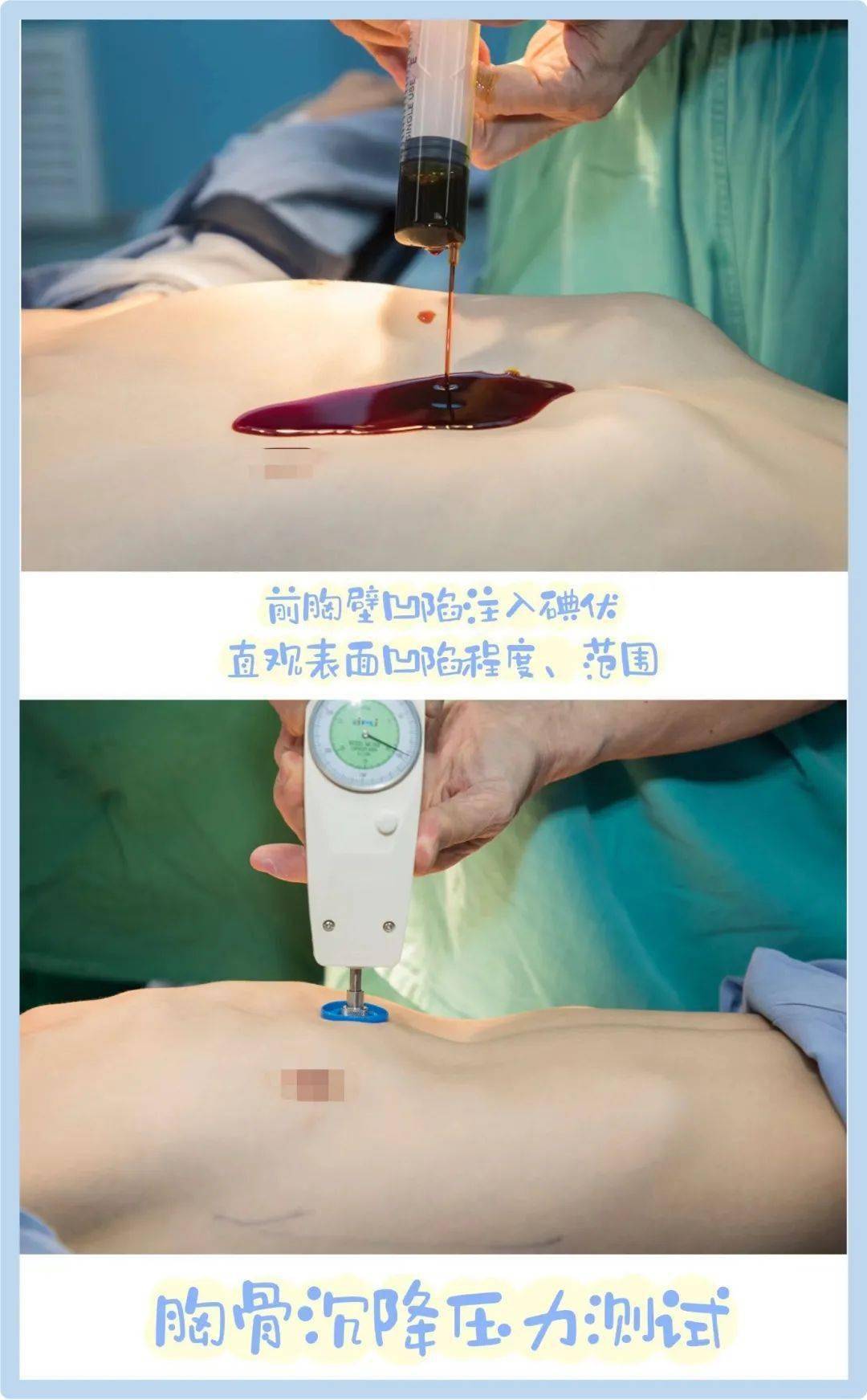 【东方播报】你是否知道:青春期是治疗鸡胸或漏斗胸的最佳时机_闫天生