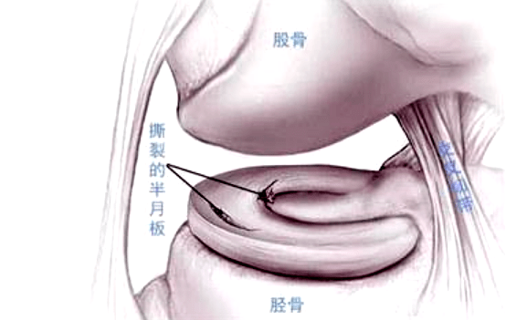 4. 半月板損傷後有哪些症狀表現?有無膝關節內其它結構的損傷?