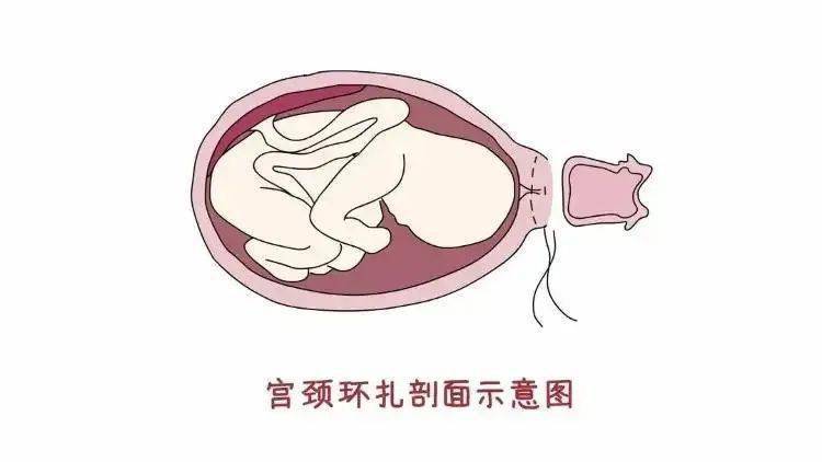 阴道检查羊膜囊已突出宫口刘女士的羊膜囊凸入宫颈管