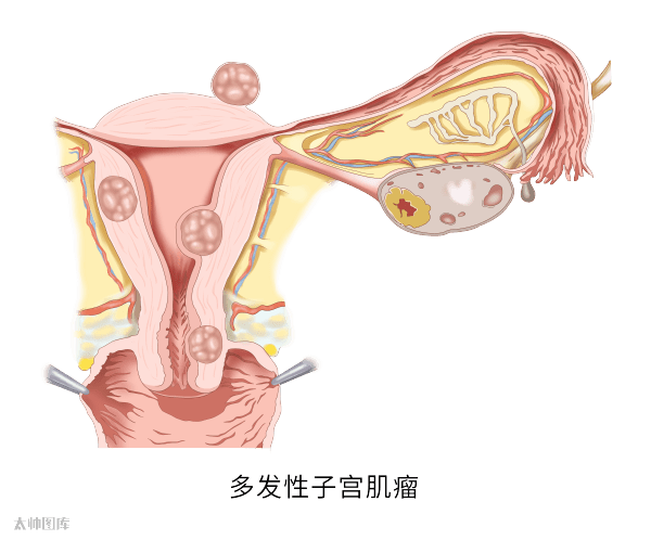 异常子宫出血的9大原因,一文全解