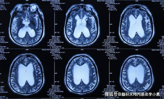 老年正常压力性脑积水:痴呆,生活不能自理,走路特别缓慢且小碎步,小便