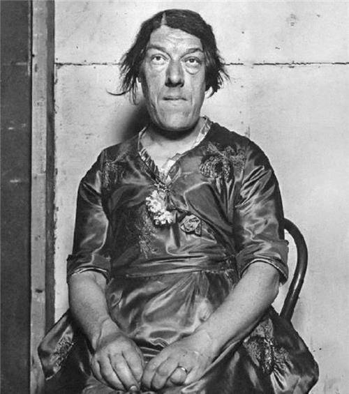 的相貌吓到后便去了医院进行检查,从而得知自己患上了"肢端肥大症",会