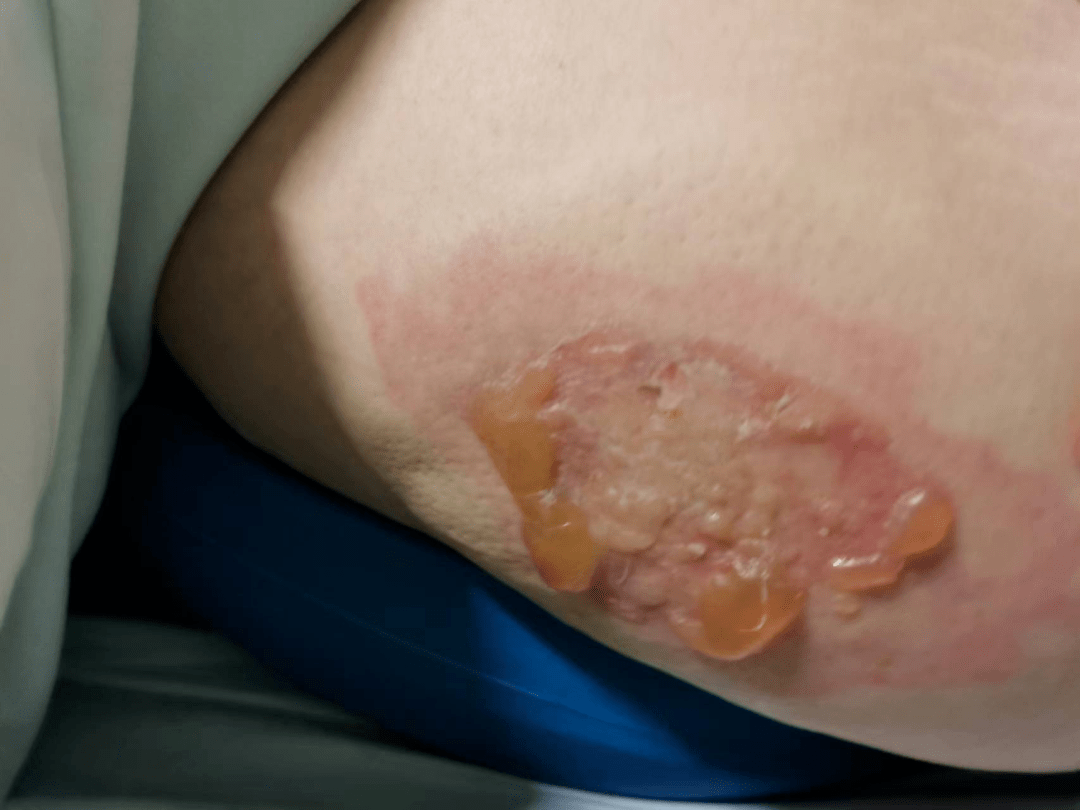 被汽车带倒在地,臀部着地,皮肤立刻烫起了大小不一的水泡