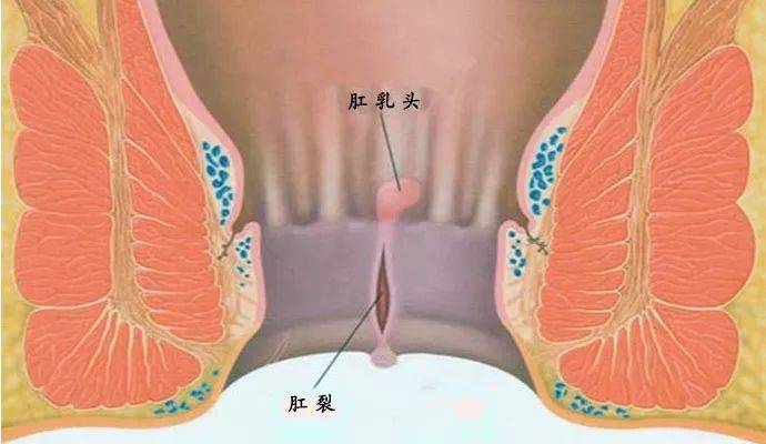 肛窦炎位置图片