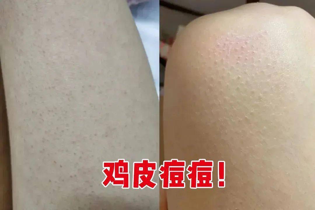 海边身上起鸡皮疙瘩(去过海边后,皮肤就痒起疙瘩怎么回事)