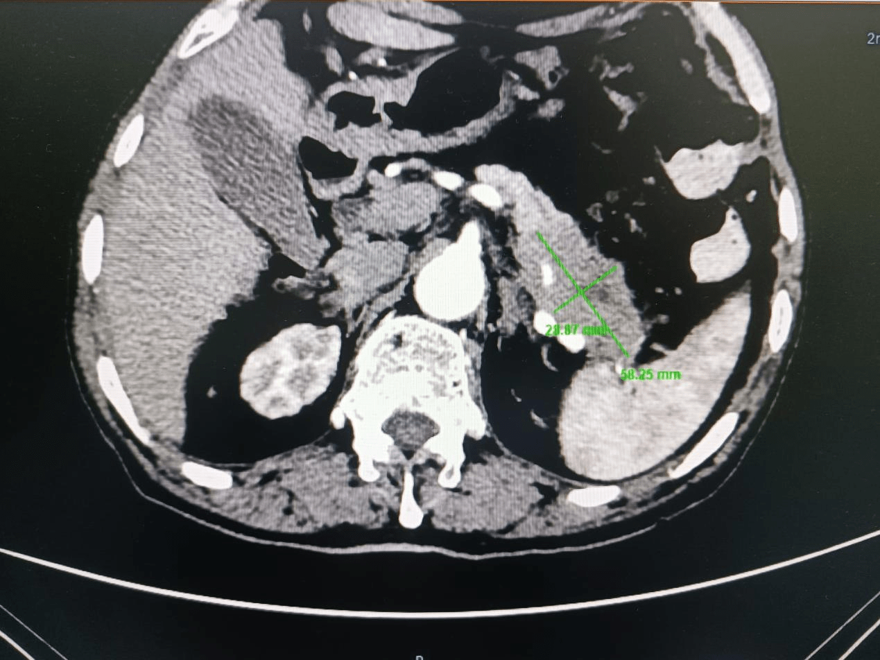 胰腺体面容图片